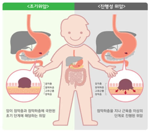 위암의 진행