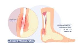종아리통증-아킬레스건염