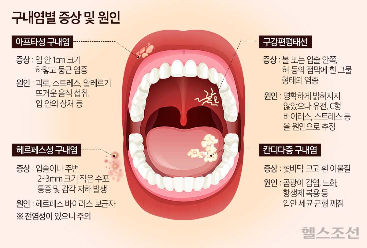 구내염의 증상과 종류 이미지