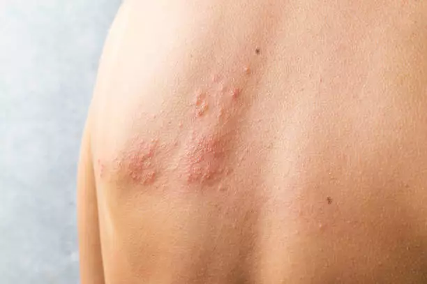 대상포진 초기증상 치료방법