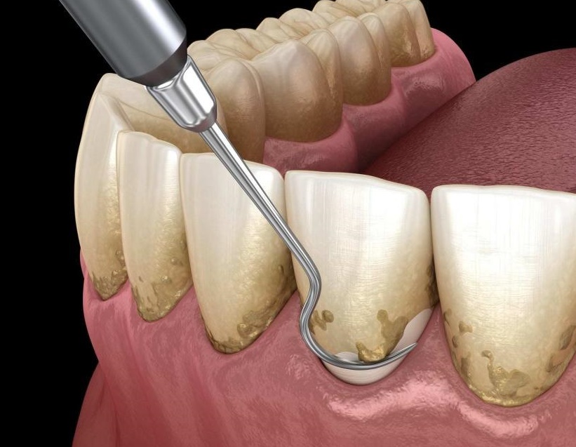 치석제거 방법