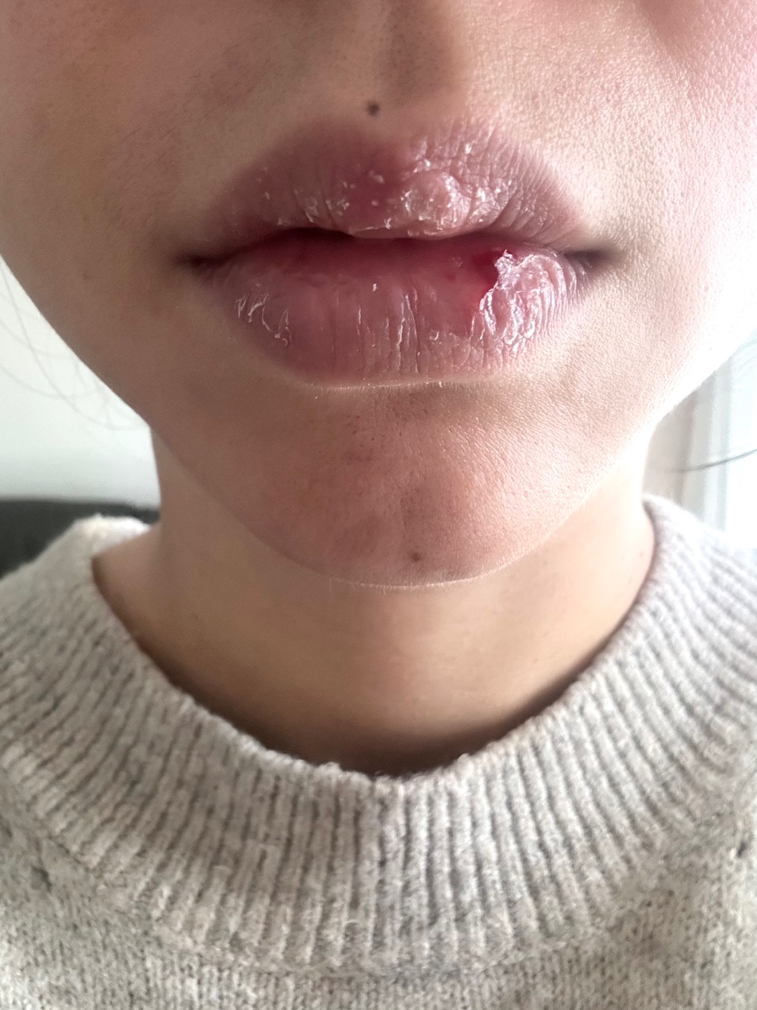  입술 접촉성 피부염..ㅜㅜ