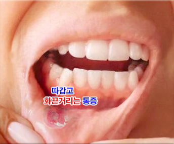 구내염 빨리 낫는 법
