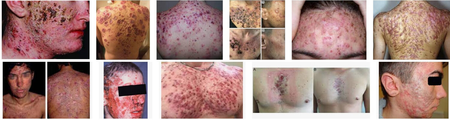 의학용어 acne fulminans 전격여드름, 전격좌창 사진 
