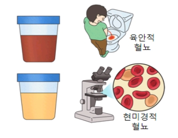  신장암 증상/원인/치료법/재발률