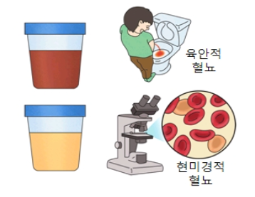 신장암