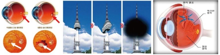 황반 변성