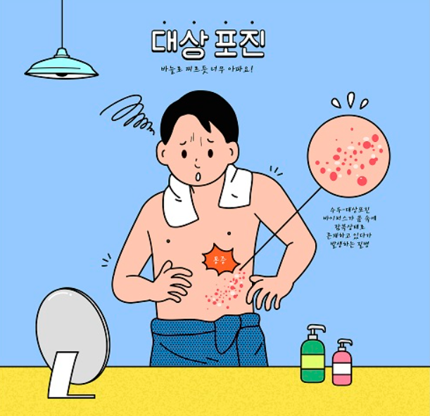 대상포진 증상과 치료