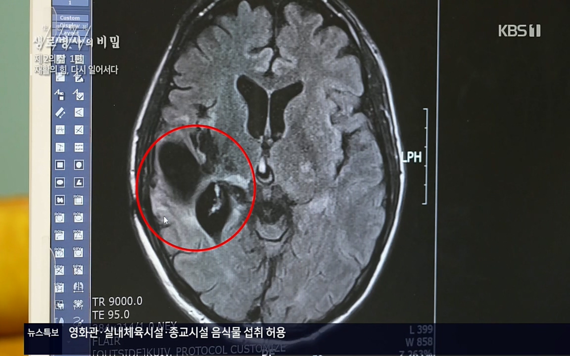 생로병사의 비밀.E819.220505p.H264-F1RST.mp4_20220508_182657.710.jpg