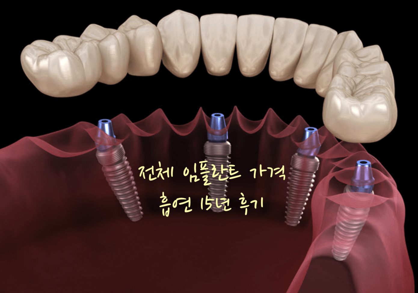 전체임플란트 가격