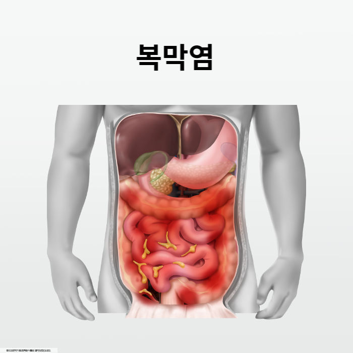 복막염