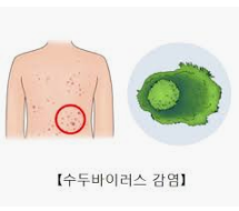  대상 포진 치료 방법 어느 병원으로 가야할까?