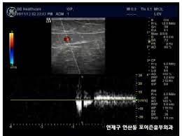 초음파 검사