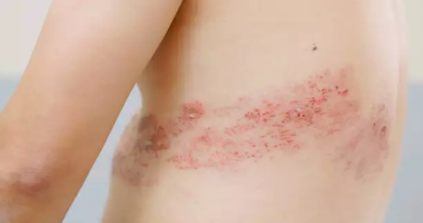 대상포진 초기증상 치료방법