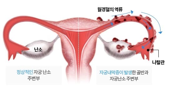 자궁내막증&amp;#44; 자궁내막증 증상&amp;#44; 자궁내막 증식증&amp;#44; 자궁내막 증식증 치료방법&amp;#44; 자궁내막증에 좋은 음식&amp;#44; 자궁내막 증식증 보험&amp;#44; 자궁내막증 피임약&amp;#44; 자궁내막증 한방치료&amp;#44; 자궁내막증 비잔&amp;#44; 자궁내막 증식증 원인&amp;#44; 자궁내막증 수술