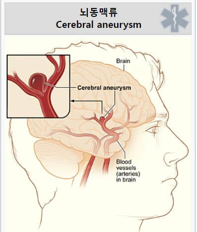 뇌동맥류 증상