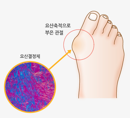 통풍