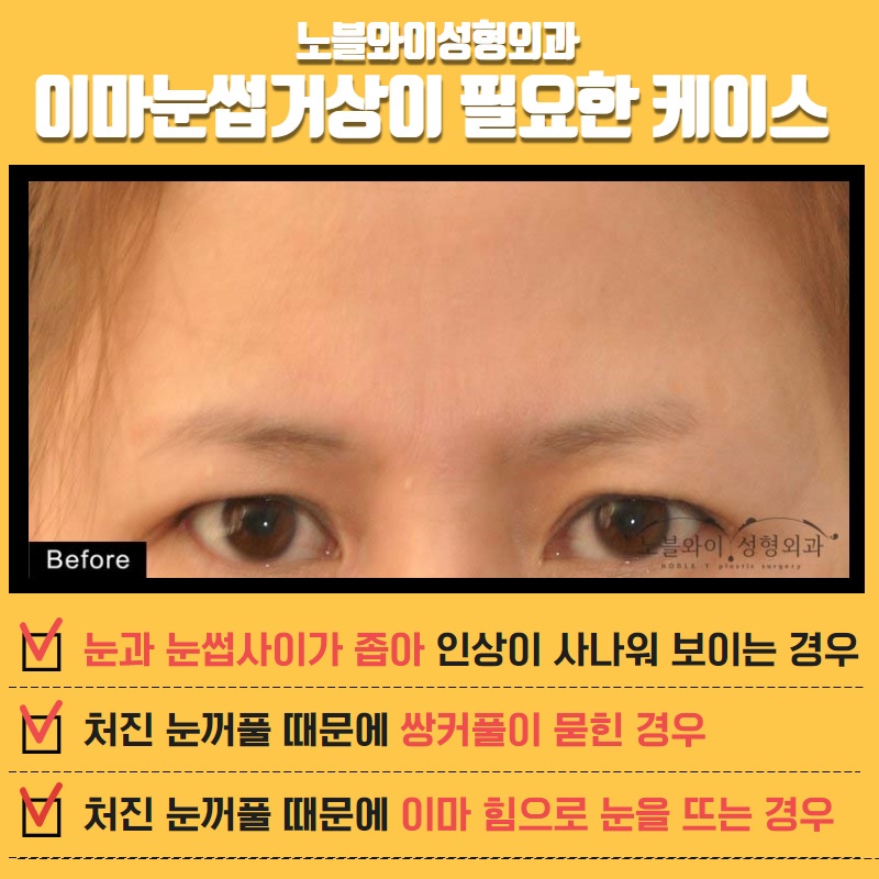  내시경이마거상술효과기간 길려면 이렇게해야