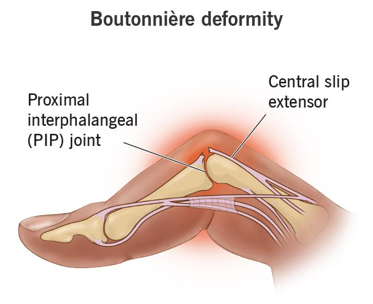 boutonniere deformity