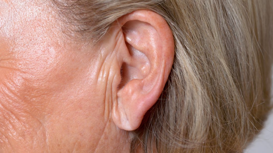 치매 뇌졸중 귀주름 연관 관계