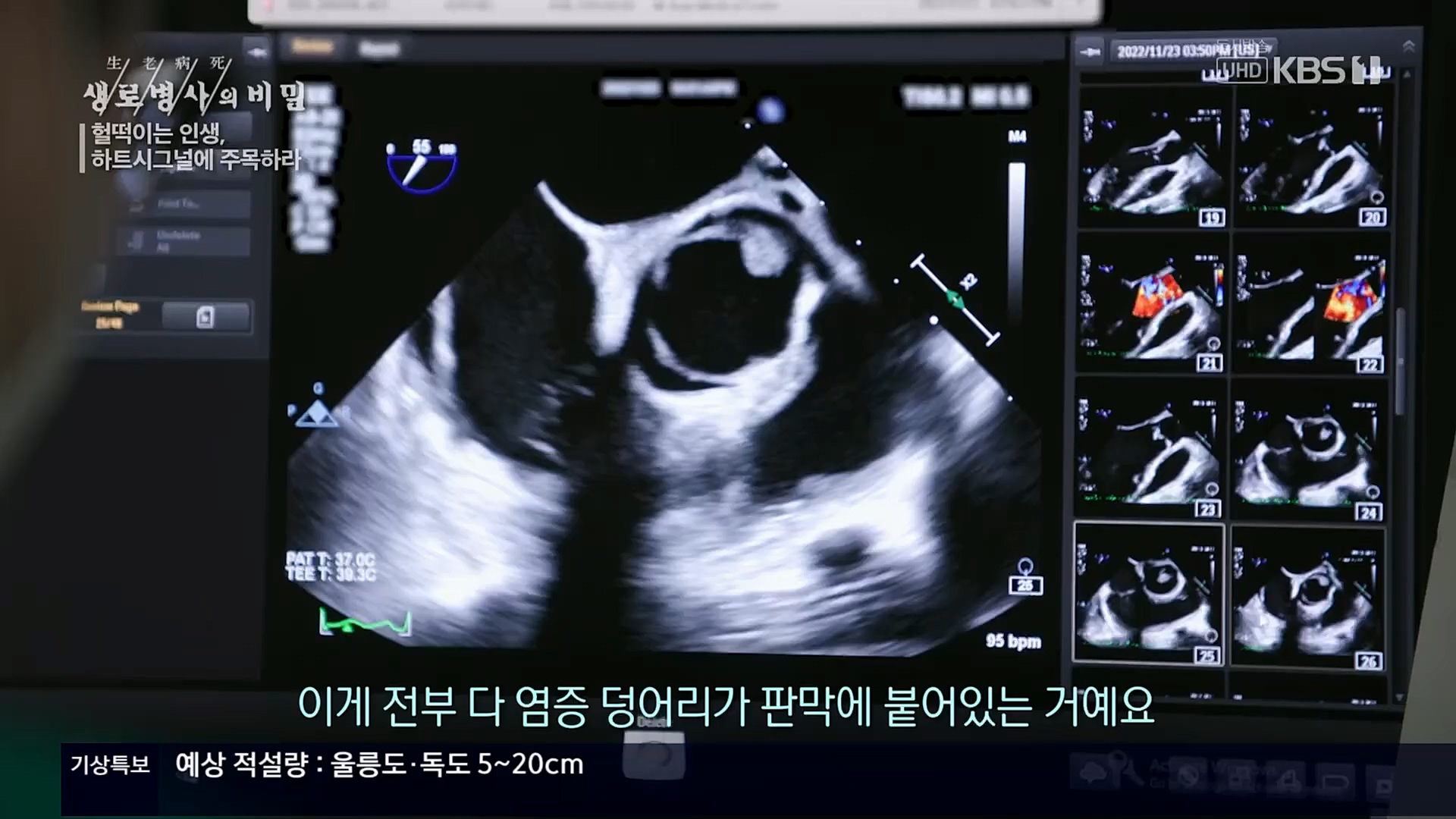 생로병사의 비밀.E853.230125p.H264-F1RST.mp4_20230210_203707.131.jpg
