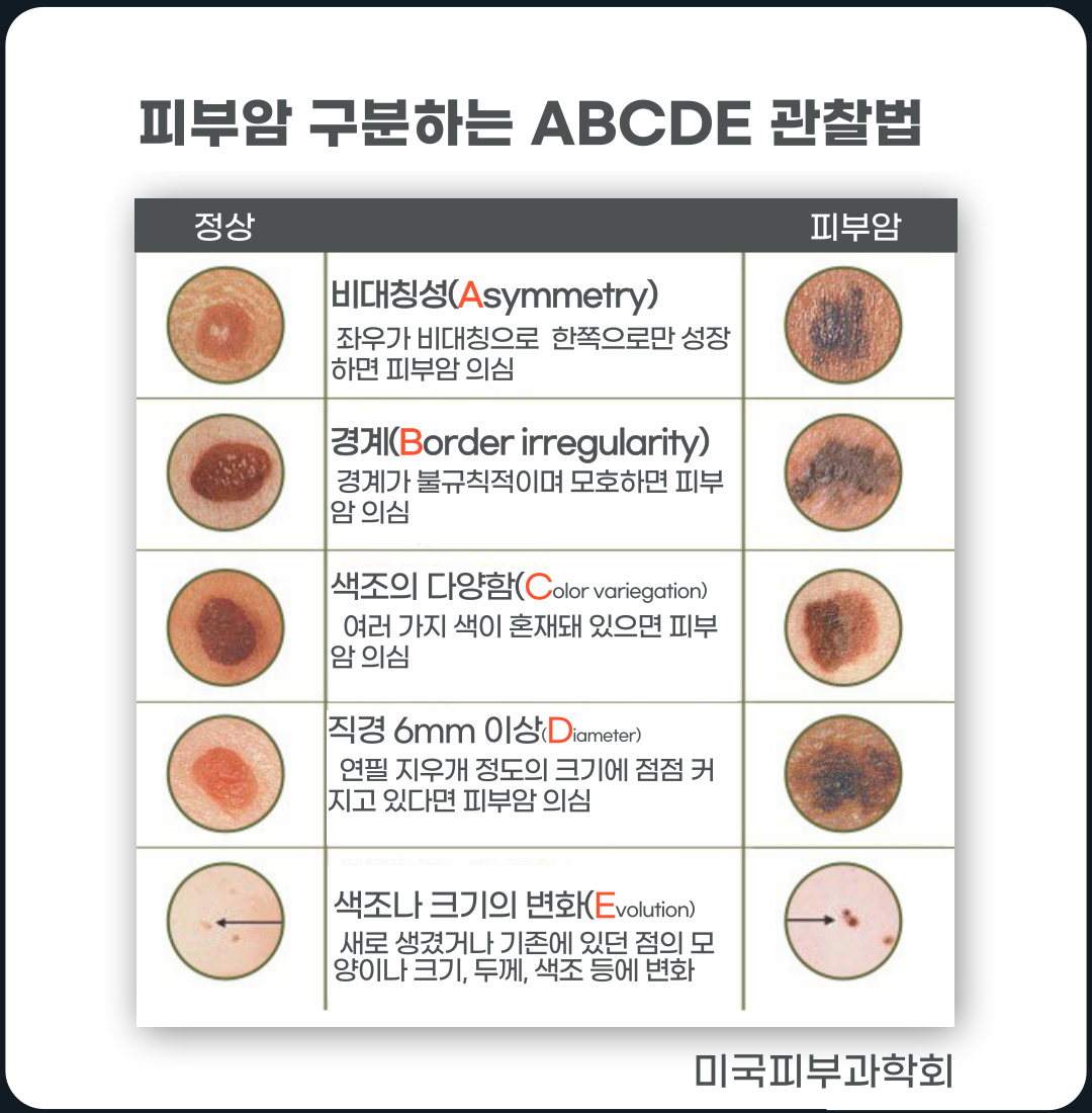  "혹시 나도 피부암..? : 피부에 숨겨진 위험"