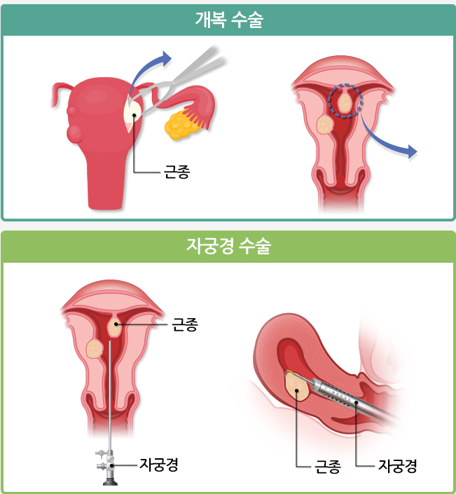 자궁수술