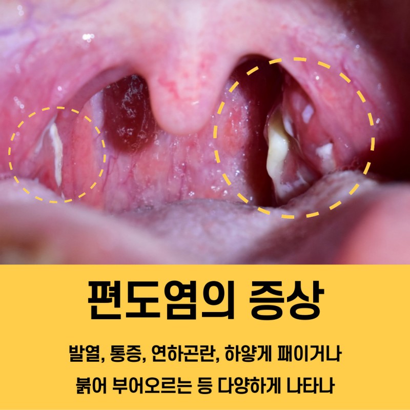  "편도염, 이렇게 방치하면 큰일 납니다! 지금 알아야 할 모든 것"