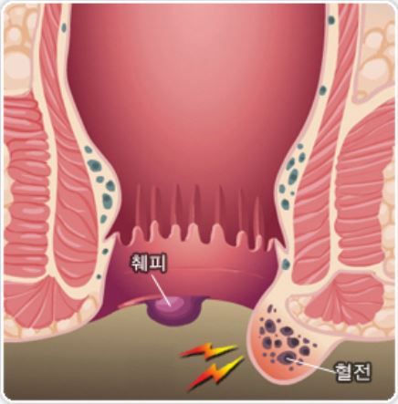 외치핵(질병관리청 국가건강정보포털)