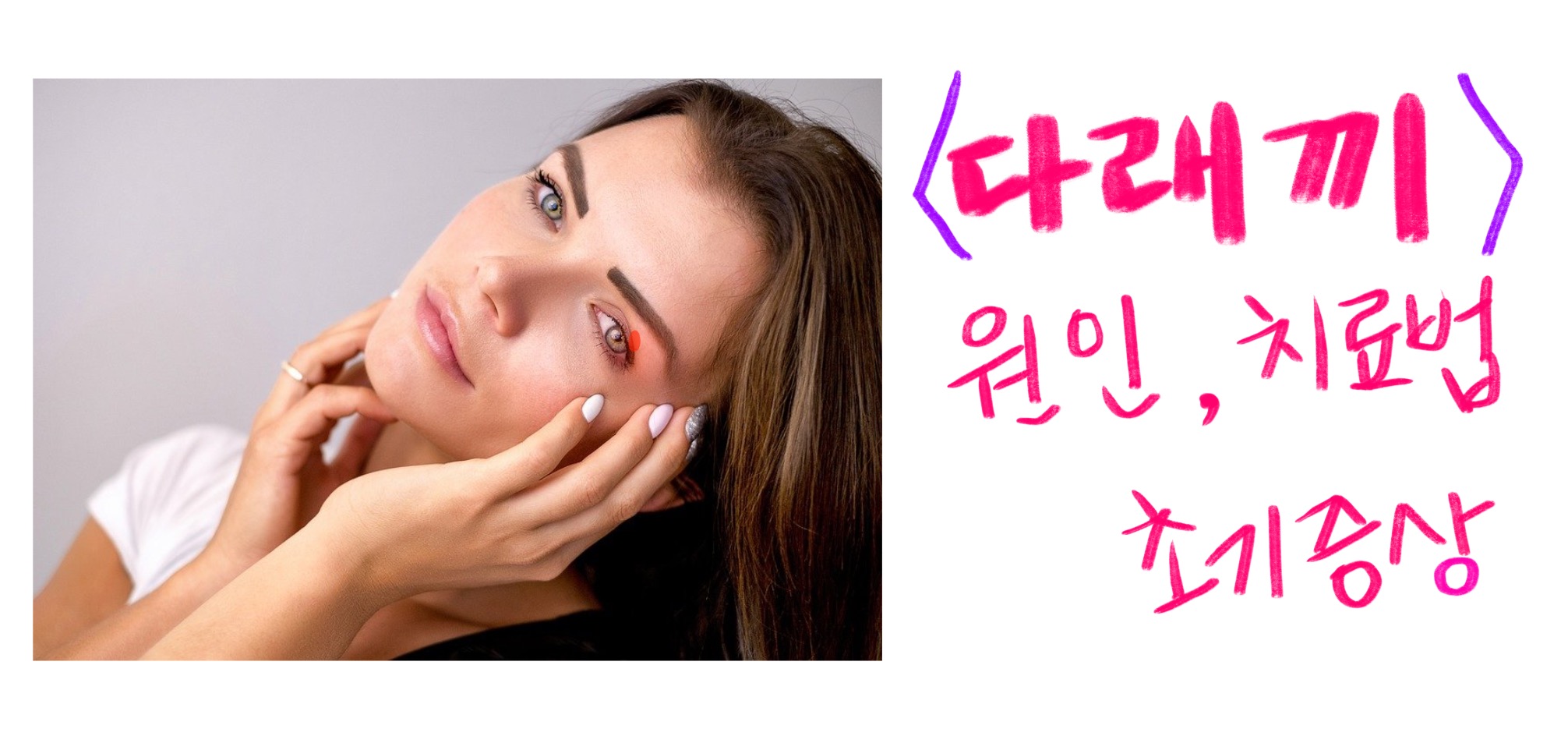  다래끼 초기증상 , 원인 , 치료법 어떻게 되나?