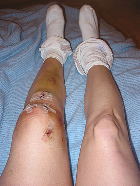 전방십자인대파열의 치료(인대재건술, 재활, 군면제)