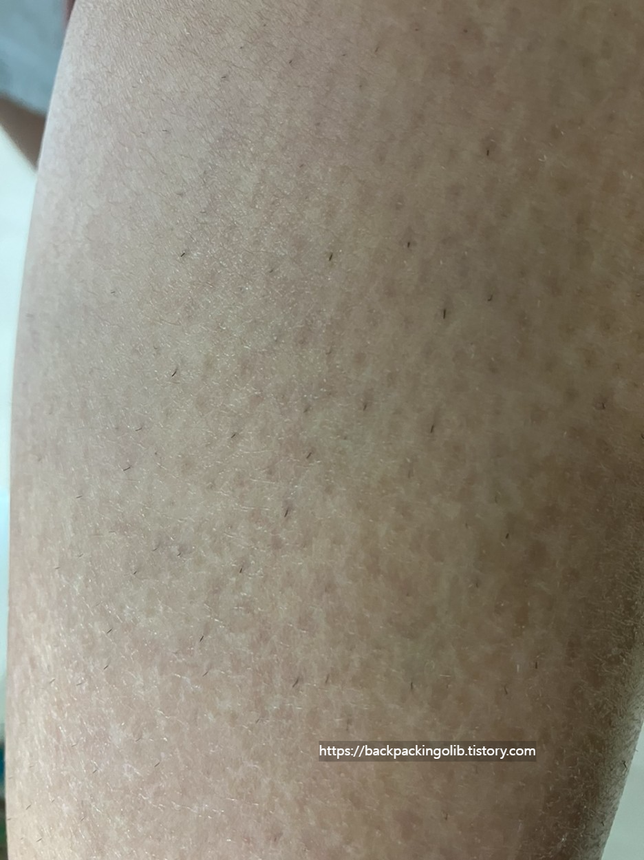 유라이크 사파이어 쿨링 제모기 조사모습