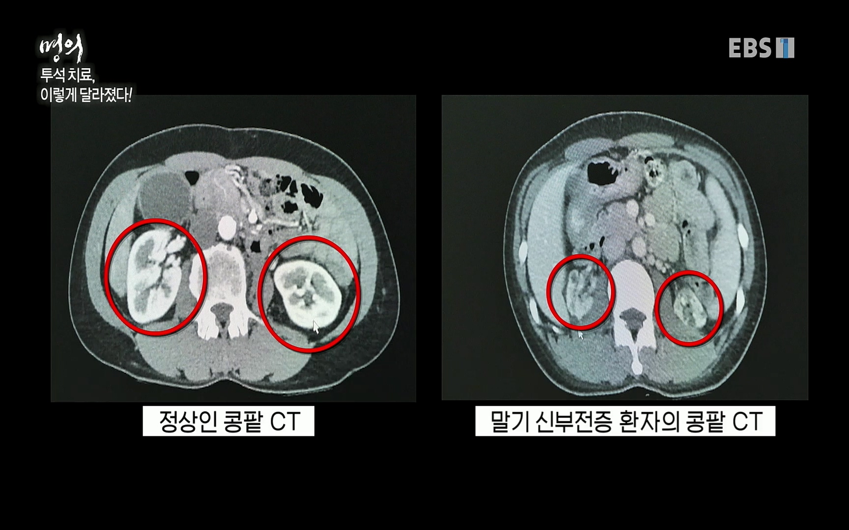 EBS 명의 헬스케어 - TV - 교육의 중심 EBS명의 15년 - 만성 콩팥병 치료, 어디까지 왔나- .mp4_20220802_205732.491.jpg