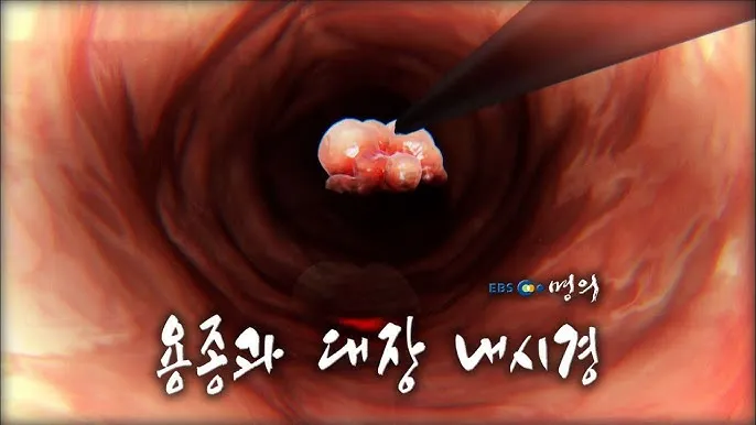 대장내시경 용종제거 후 식사 식단조절_4