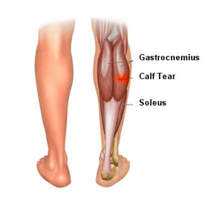 종아리 근육 부상
