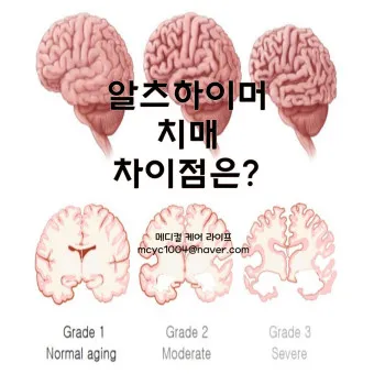 알츠하이머와 치매 차이_12