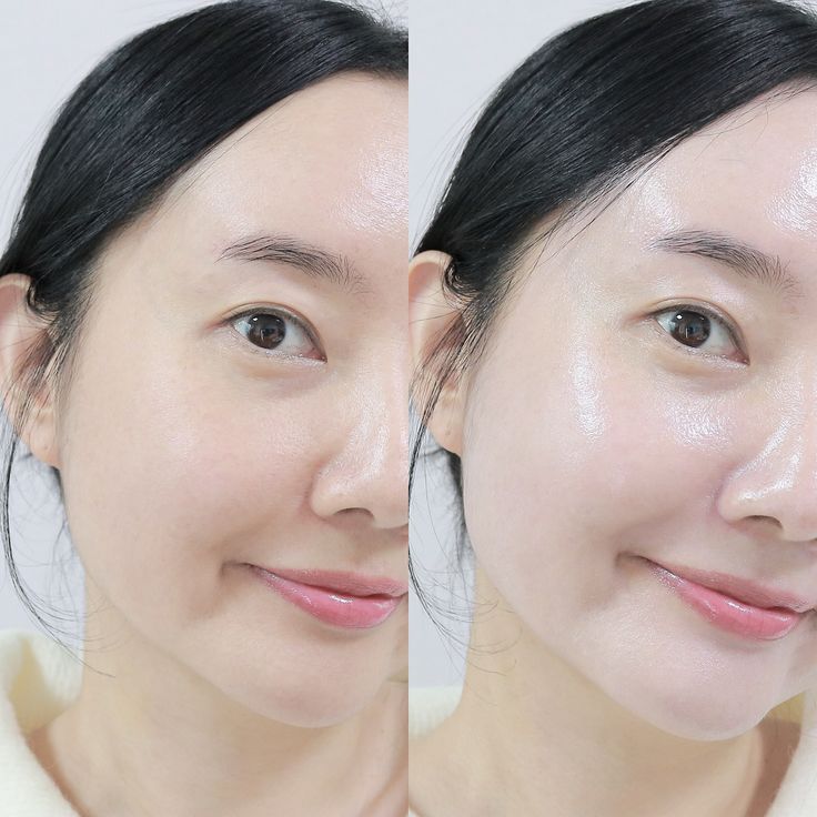 물광 피부 시술 전, 후 사진