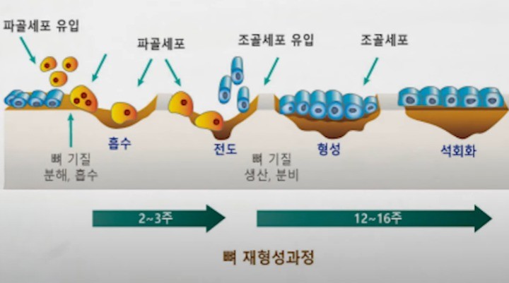  골다공증 생기는 원인과 예방 치료방법