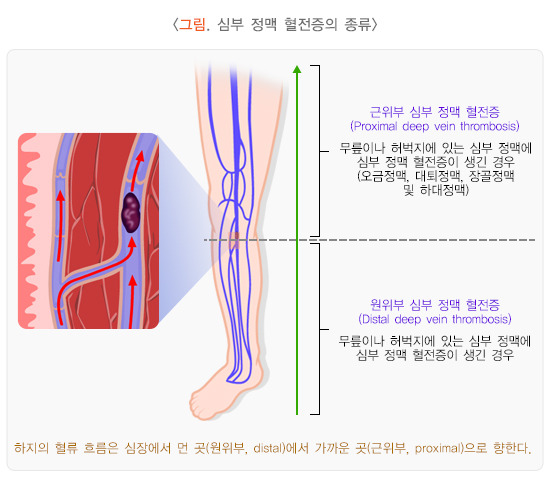 심부 정맥 혈전증의 종류