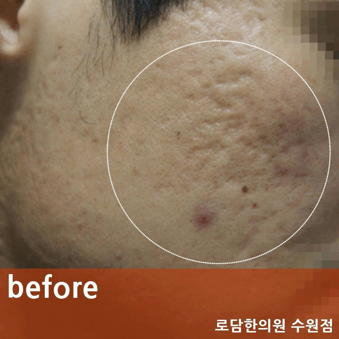  볼 여드름 자국 패인 흉터 제거 새살침 코라테라피 치료 과정