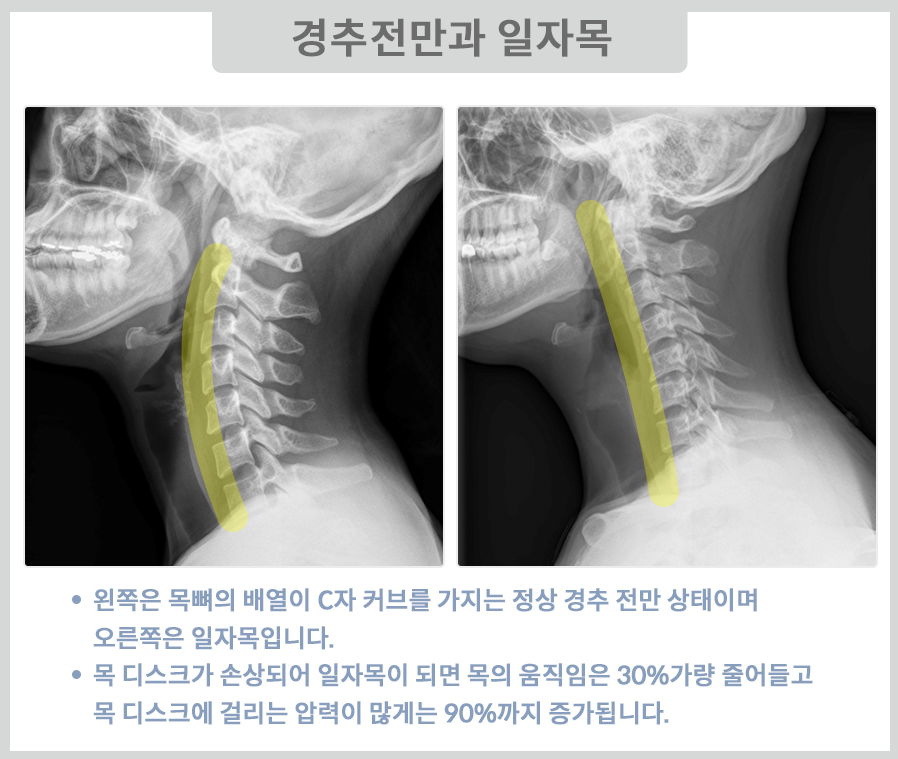 경추전만과 일자목