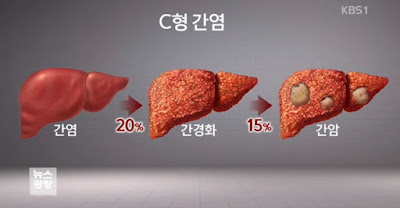 만성 간염 알아보기(원인, 증상, 예방, 치료)