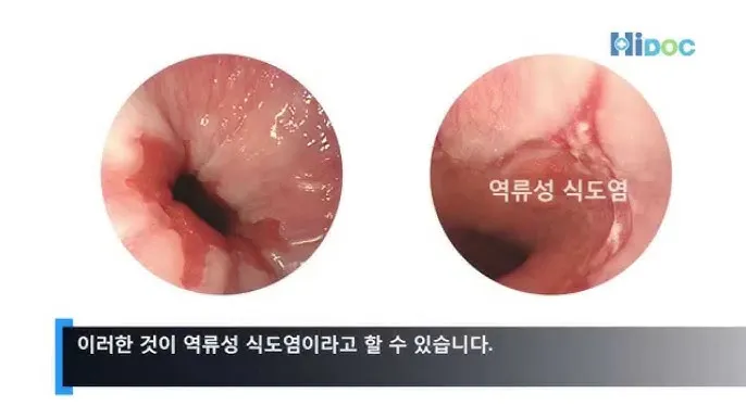 역류성 식도염 원인 초기증상 예방하는 방법_3
