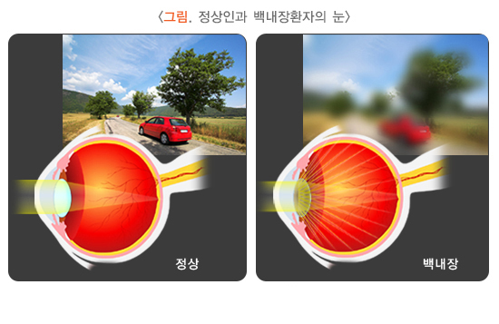 정상인과 백내장 환자의 눈