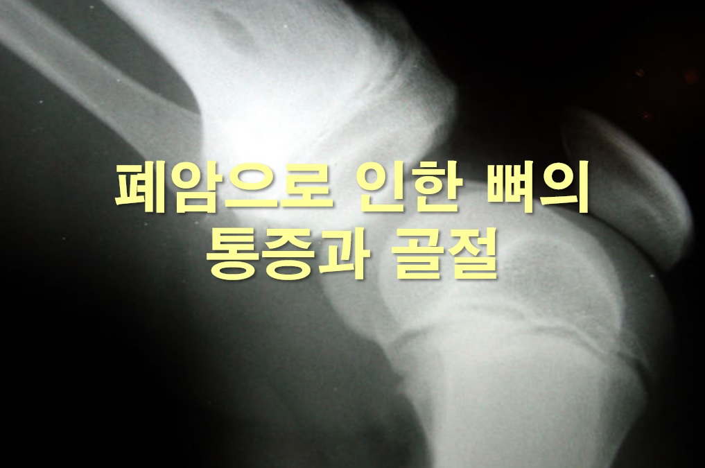  폐암으로 인한 뼈의 통증과 골절