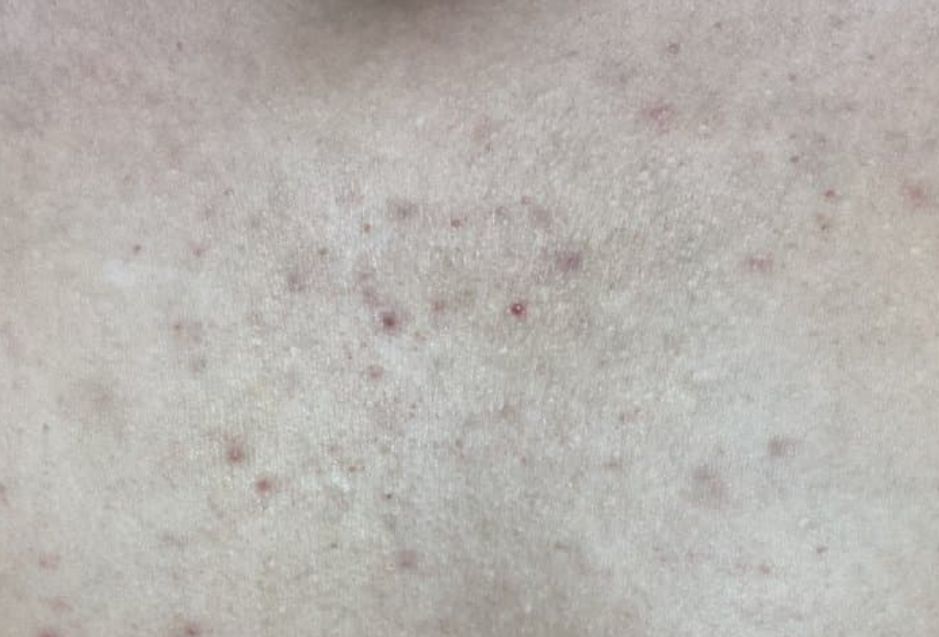 등드름 가드름 쉽게 없애는 법 1