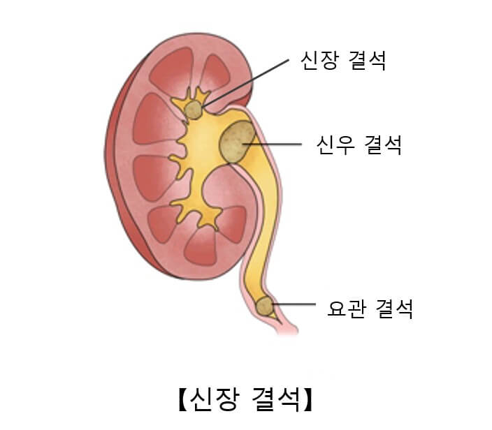 요로결석 과정을 보여주는 그림