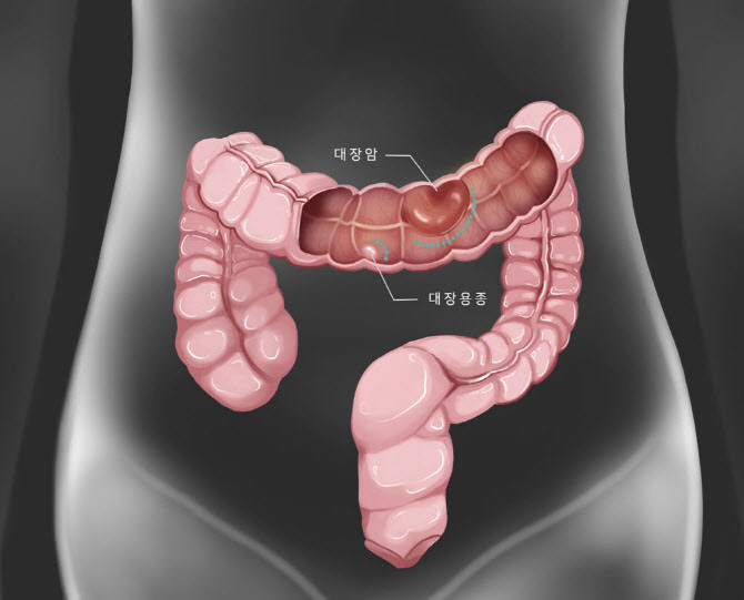 방귀가 자주 나오는 원인