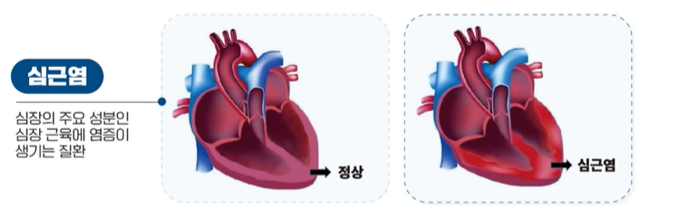 심근염