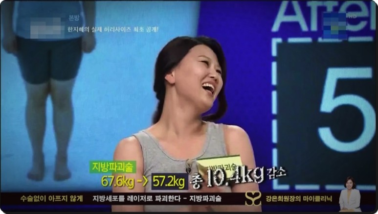 셀룰라이트 제거까지 지방파괴술 효과, 뱃살 다이어트부터 복부 4